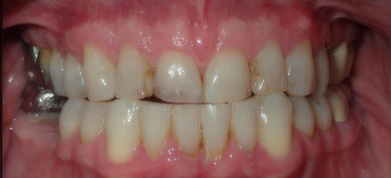 Smile with missing and damaged front teeth before implant restoration