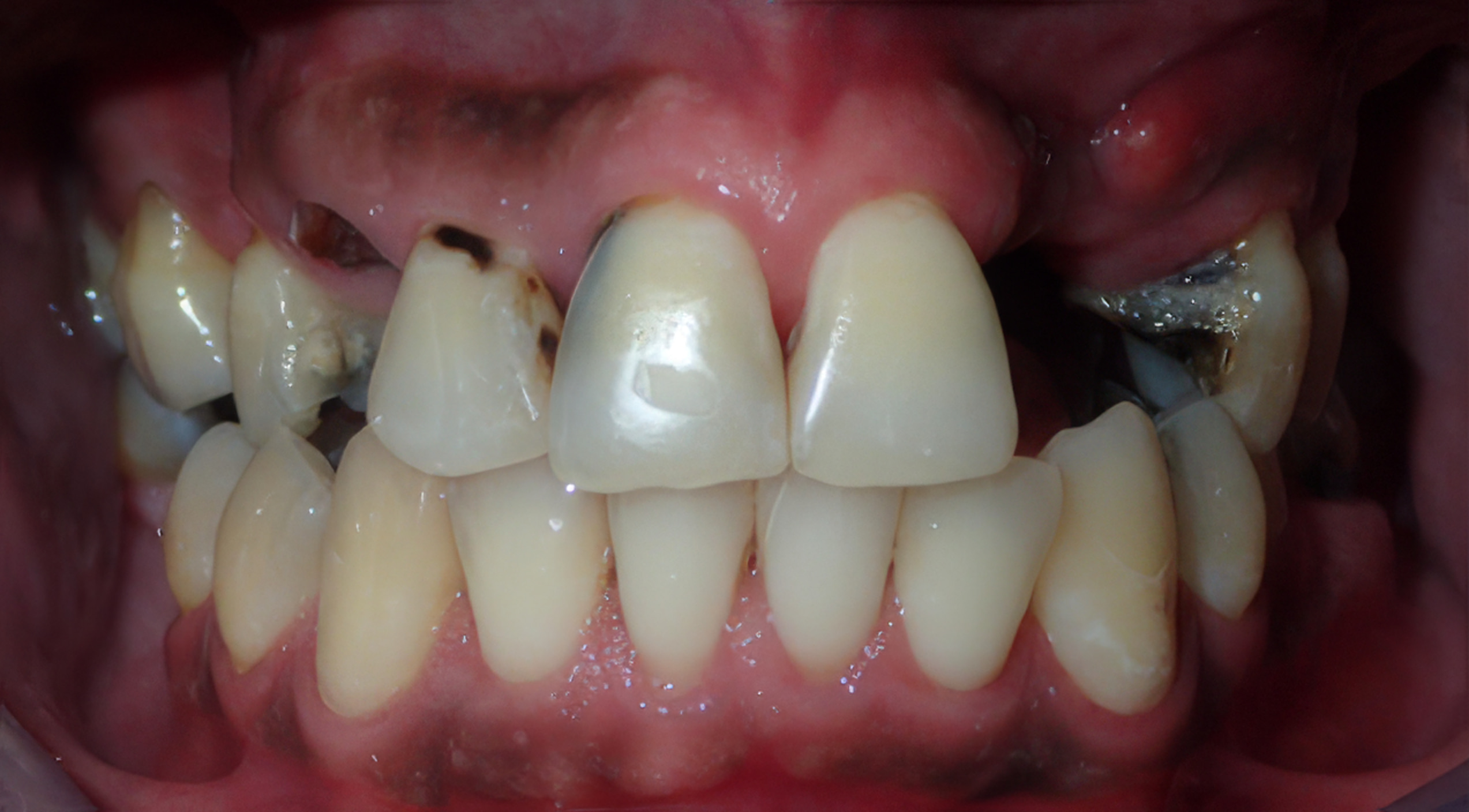 Worn, discolored smile before porcelain veneers