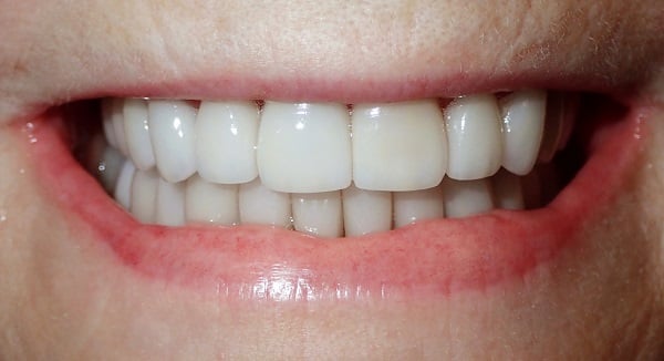 Smile after restoration